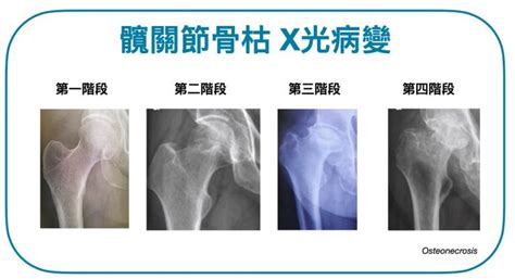 為什麼會骨枯|【01醫務所】髖關節骨枯病人難自覺患病 高危人士需。